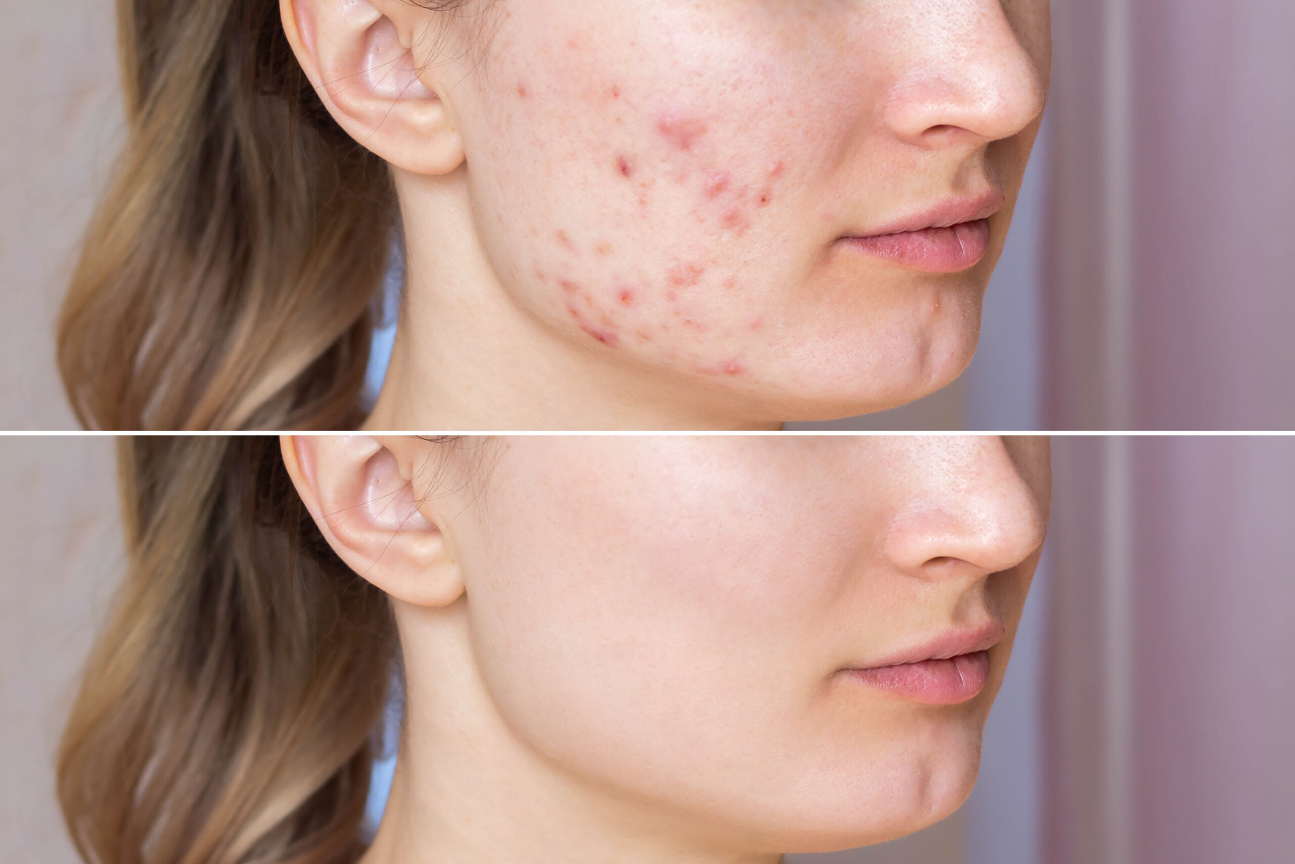 jongeren-met-acne-behandeling