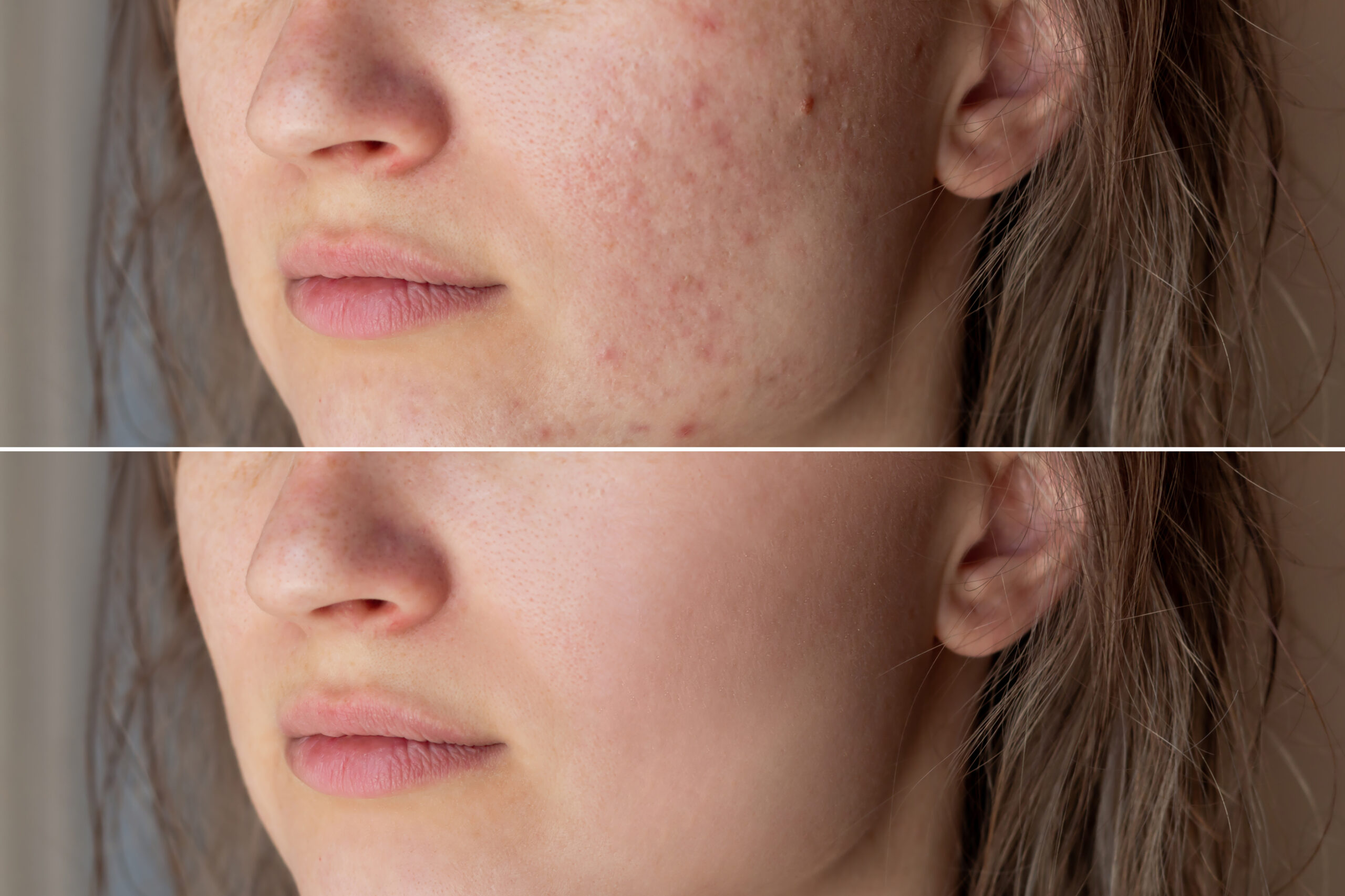 acne-behandeling-onzuiverheden-debora-amsterdam